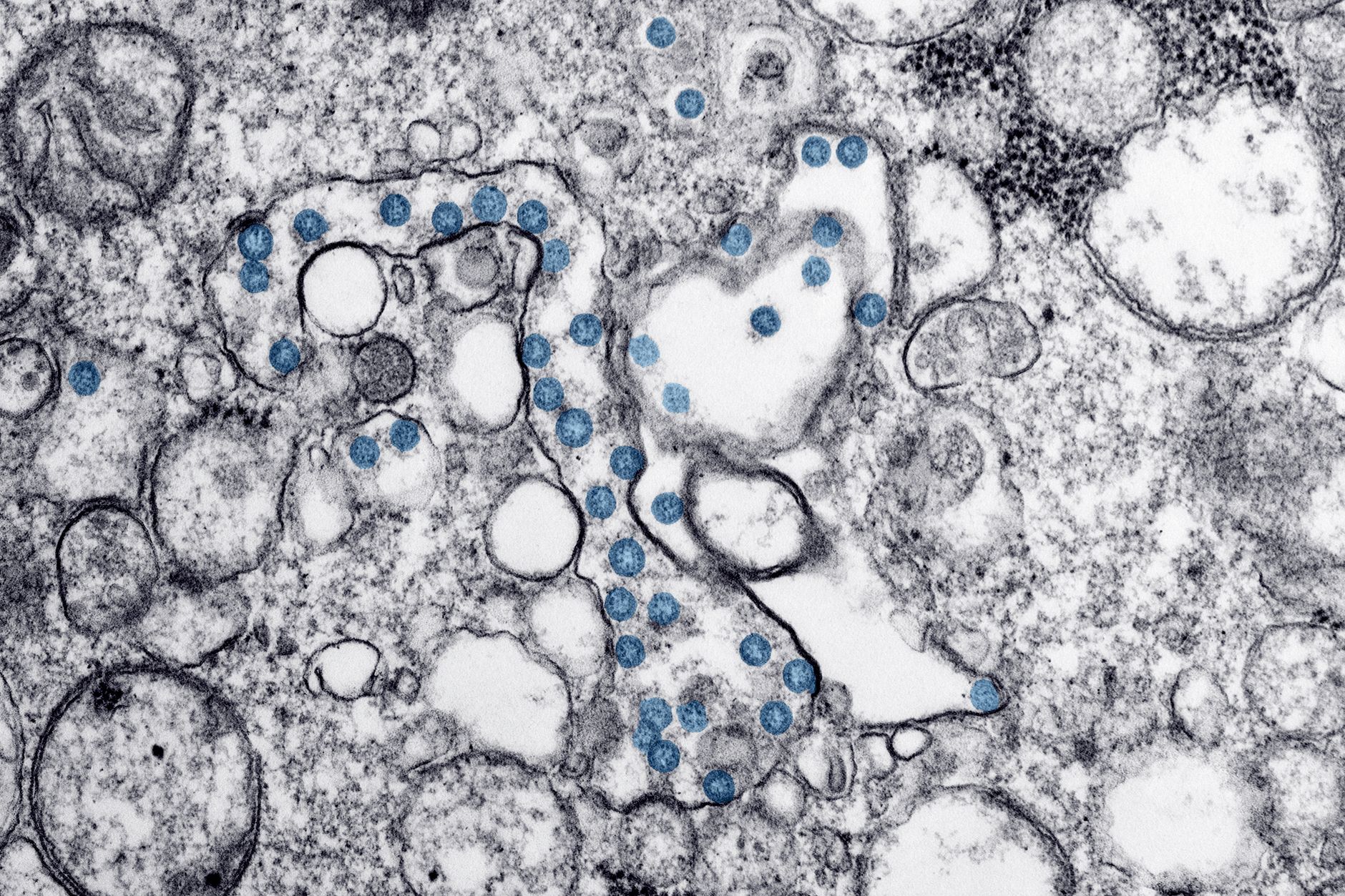Quebec researchers find potential pathway to halt ALS progression